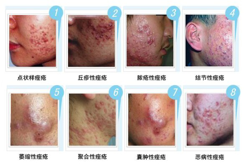 湿疹治疗的最新进展与趋势